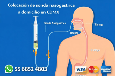 Anuncio de colocación de sonda nasogástrica a domicilio en CDMX con ilustración del recorrido hacia el estómago, número 5568524803 y pago con Visa, MasterCard y American Express